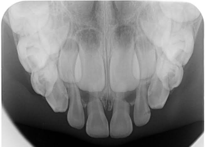 OCCLUSAL X-RAY at Careful Diagnostic Centre 