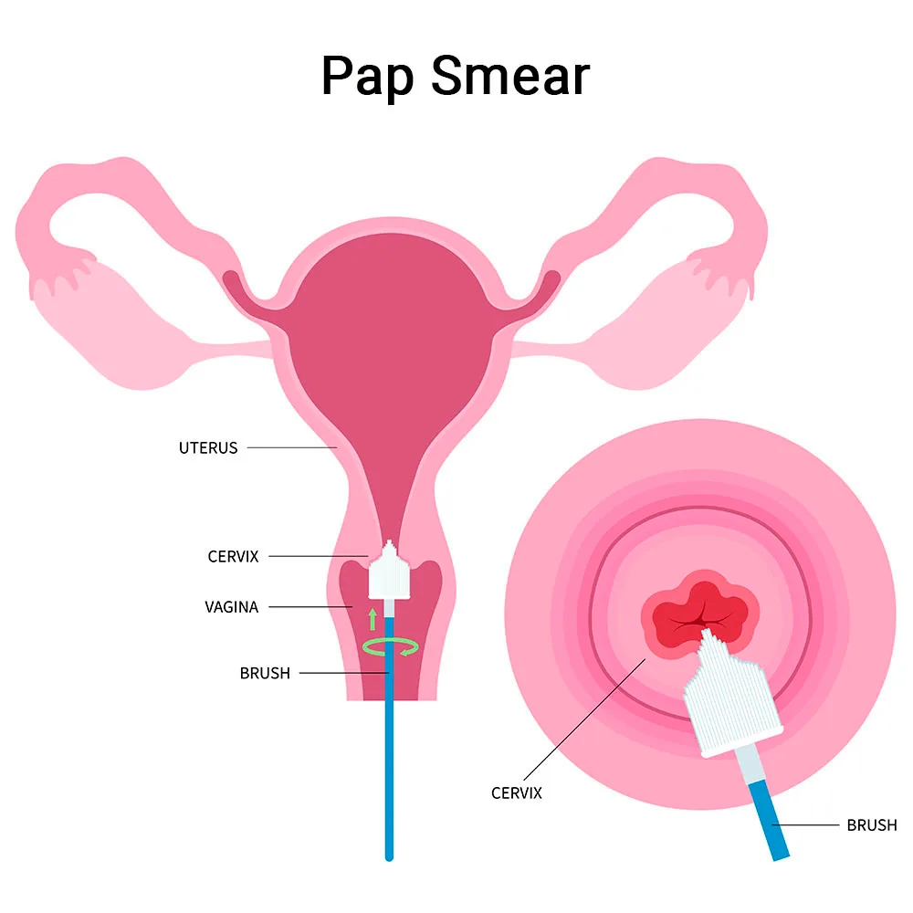PAP SMEAR (Papanicolaou Smear) at Careful Diagnostic Centre 